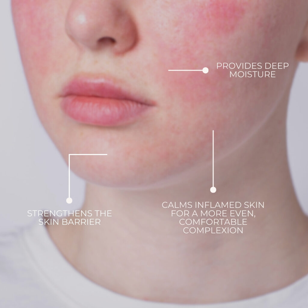 Rosacea Kit – Worth 327$