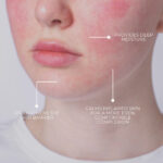 Rosacea Kit – Worth 327$