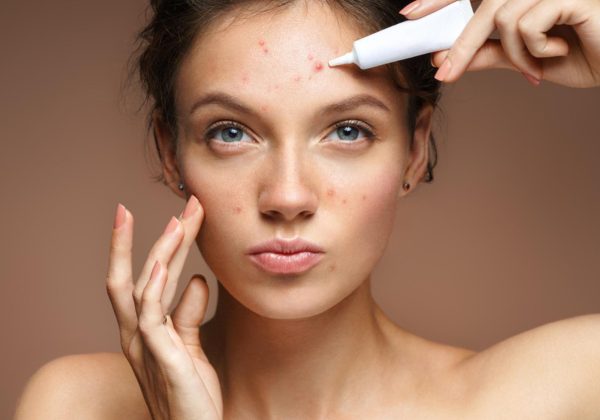 acne-causes-and-acne-treatment-model